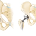 Joint Replacement Surgery: A Patient's Guide to Preparing for and Recovering from Total Joint Replacement