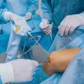 Minimally Invasive Orthopedic Treatment: Understanding Arthroscopic Knee and Shoulder Surgery