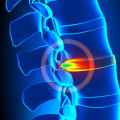 Herniated Discs: A NJ Patient’s Guide to Symptoms, Treatment and Recovery