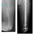 What to Expect from Fracture Repair Surgery: A Guide to Broken Bone Treatment and Rehab