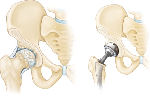 All You Need to Know About Joint Replacement Surgery