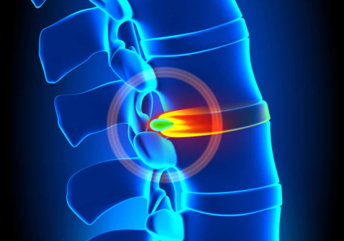 All You Need to Know About Herniated Discs