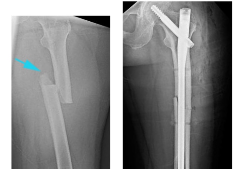 Fracture Repair Surgery: A Comprehensive Guide to Orthopedic Treatment and Rehabilitation